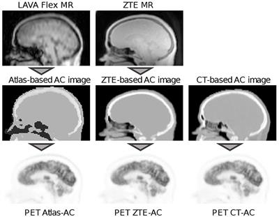 Regional Accuracy of ZTE-Based Attenuation Correction in Static [18F]FDG and Dynamic [18F]PE2I Brain PET/MR